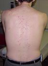 Dermatitis Herpetiformis