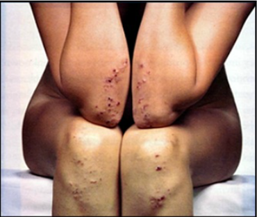 Dermatitis Herpetiformis on Elbows and Knees Caused by Celiac Disease