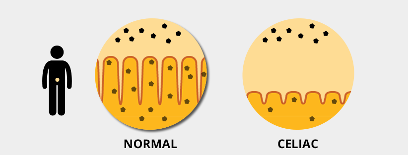 Graphic comparing normal small intestine to one in a patient with celiac disease