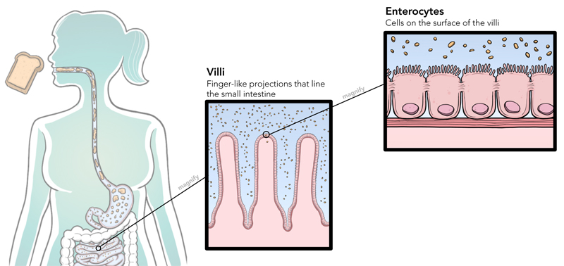 How To Prevent Coeliac Disease