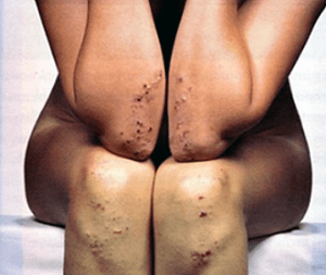 Dermatitis Hereptiformis Celiac Rash Picture
