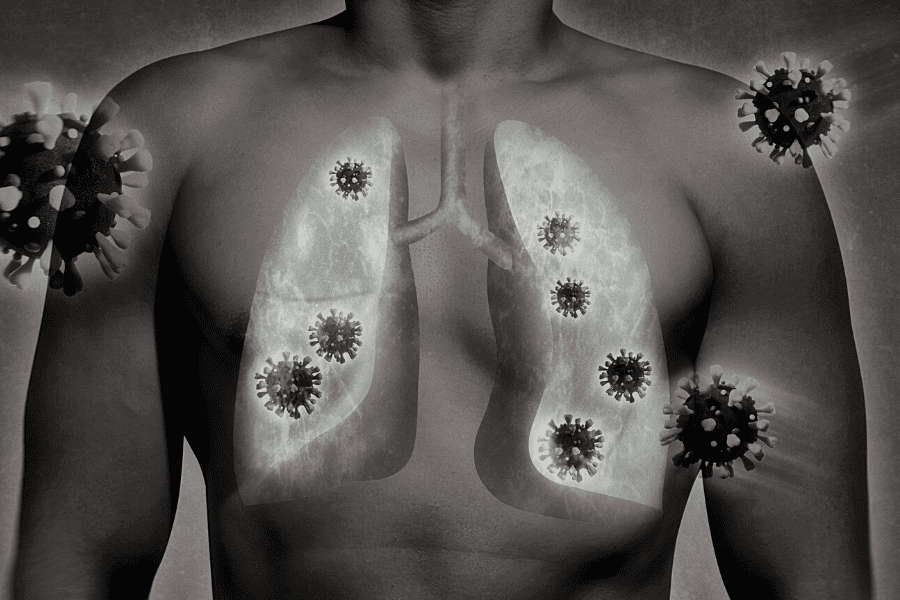 Celiac disease drug and implications for lung injury and respiratory distress in COVID-19