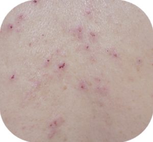 An up-close photo of the dermatitis herpetiformis rash.