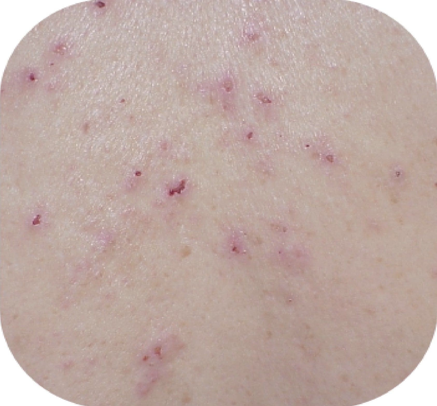 Dermatitis Herpetiformis Symptoms Testing BeyondCeliac