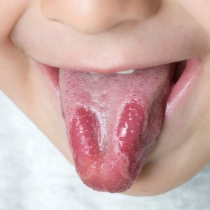 A child sticking their tongue out. The tongue is mostly pink, but there are smooth, red patches, too.