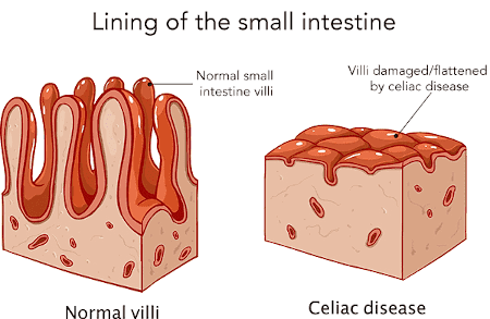 Illustration of damage to the small intestine due to celiac disease